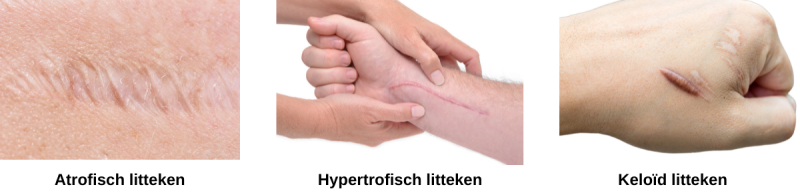 hypertrofisch litteken