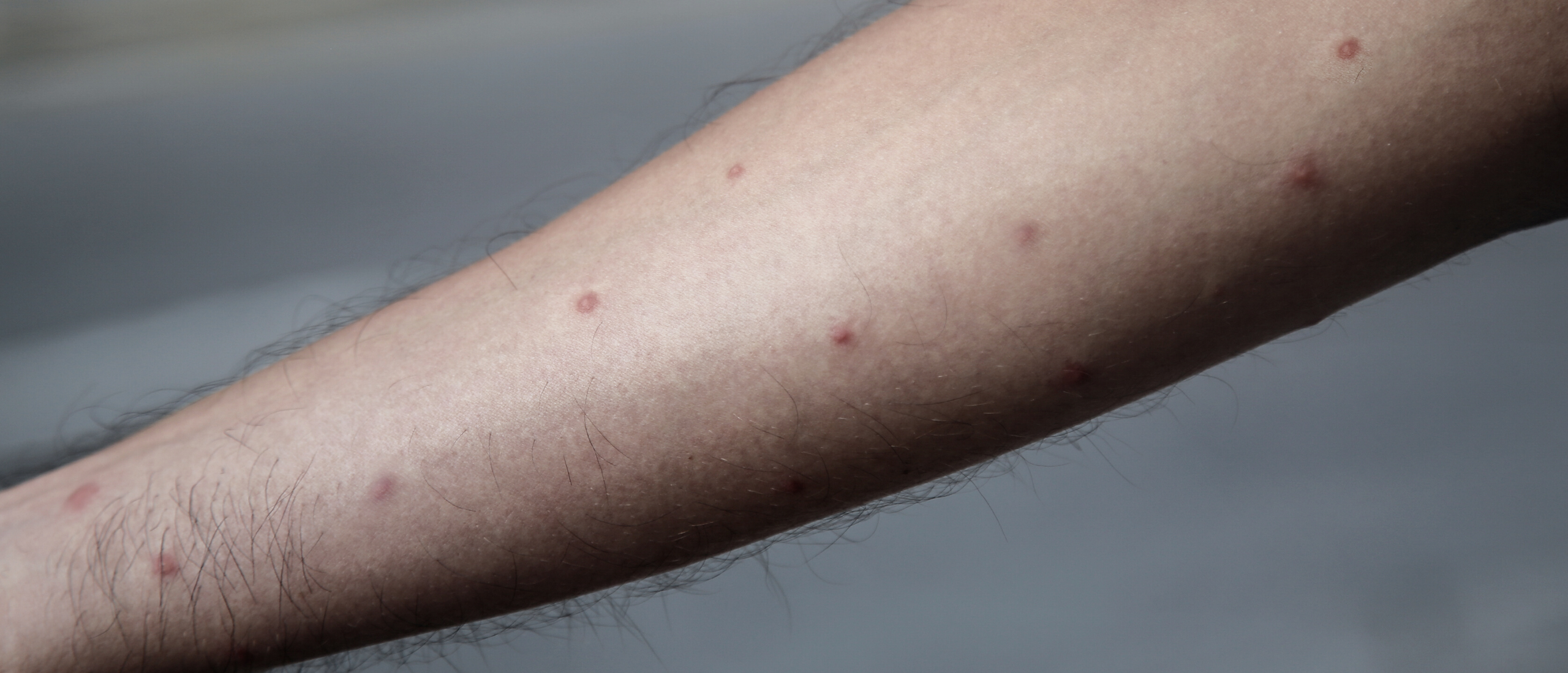 Muggenbulten: zwelling na muggenbeet