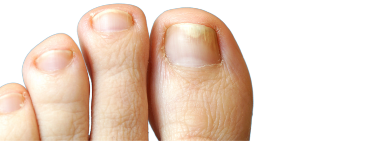psoriasis nagels