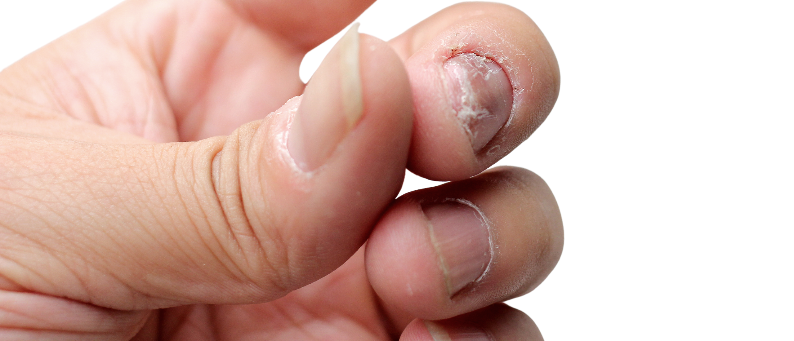 Psoriasis nagels: verkleurde nagels met deukjes