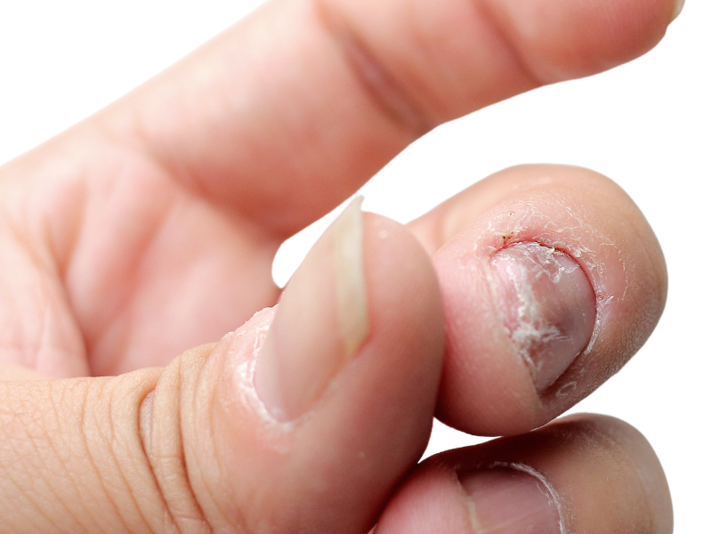 psoriasis nagels