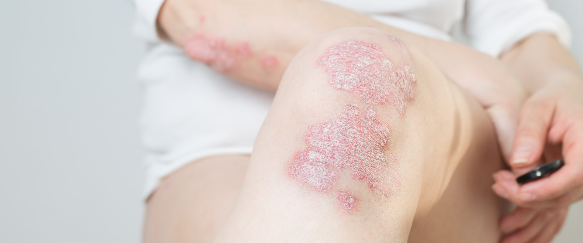 Psoriasis: roze, schilferende, jeukende plekken