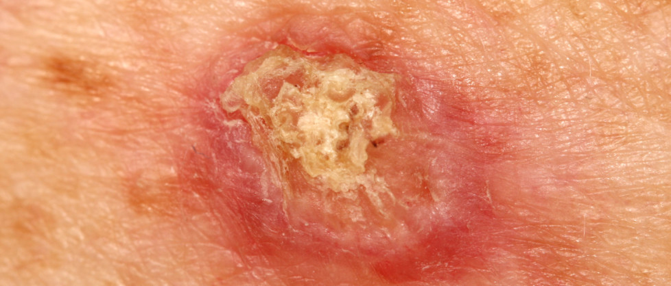 Melanoom | Huidkanker | Sproet