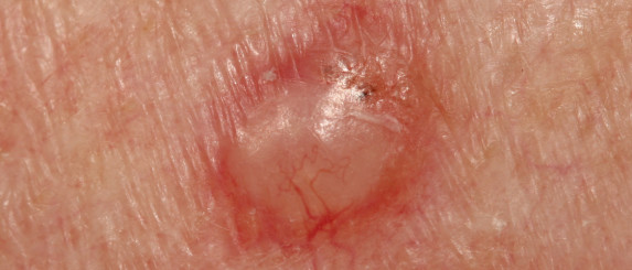Plaveiselcelcarcinoom: huidkanker