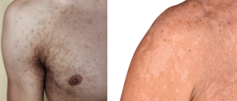 Pityriasis versicolor: witte of bruine vlekken op huid schimmel