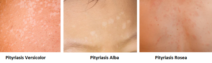 pityriasis-alba-witte-vlekjes-op-de-huid-sproet