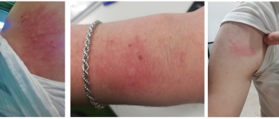 Urticaria: jeukende rode galbulten