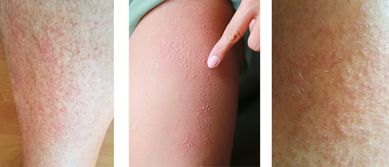 Winterbenen | Oorzaak en behandeling | Sproet