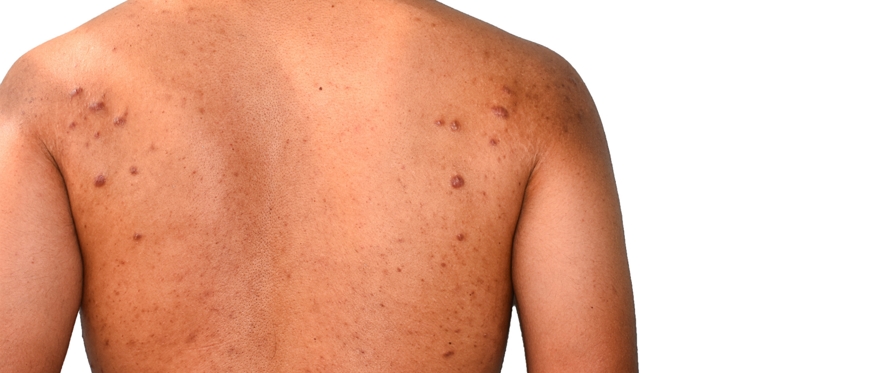 Acne Keloidalis Oorzaak en behandeling Sproet