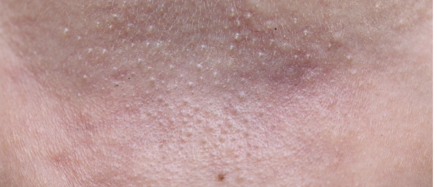 Warmtebultjes | Oorzaak en Tips | Sproet