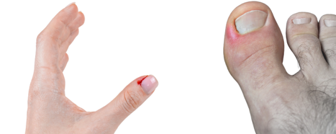 Kapotte nagelriemen | Mijn tips! | Sproet