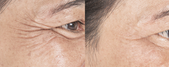 Rimpels | Oorzaak en tips | Anti rimpel crème | Sproet