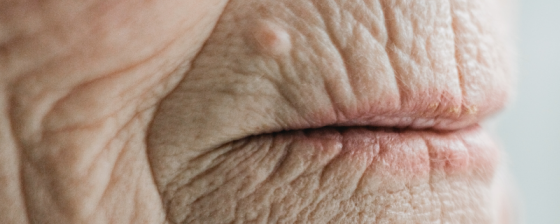 Rimpels | Oorzaak en tips | Anti rimpel crème | Sproet