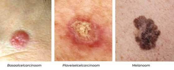 Basaalcelcarcinoom | Huidkanker | Sproet
