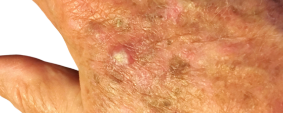 Actinische Keratose Voorstadia Van Huidkanker Sproet actinische-keratose-voorstadia-van-huidkanker-sproet