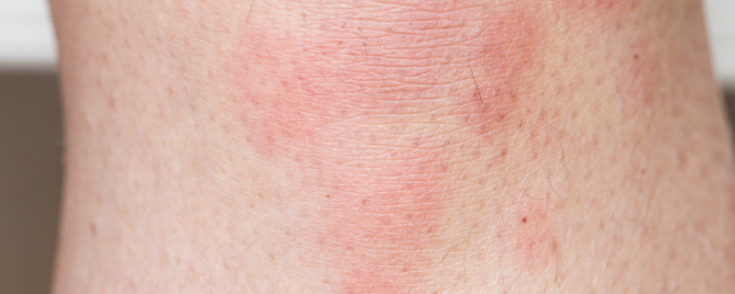 Rode Bultjes Op Benen Jeuk