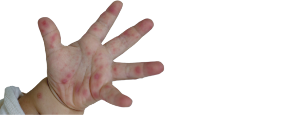 Hand voet mondziekte | Oorzaak en tips | Sproet