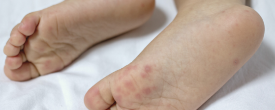 Hand voet mondziekte | Oorzaak en tips | Sproet