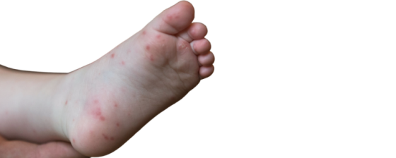 Hand voet mondziekte | Oorzaak en tips | Sproet