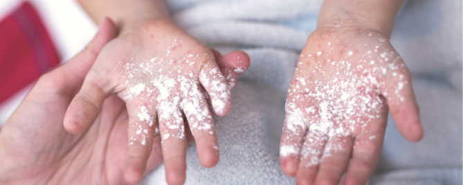 Hand voet mondziekte | Oorzaak en tips | Sproet