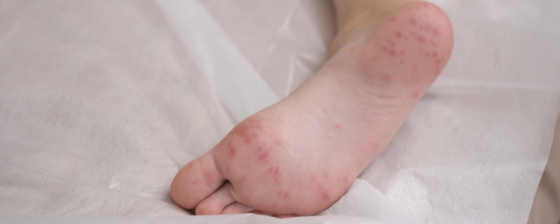 Hand voet mondziekte | Oorzaak en tips | Sproet