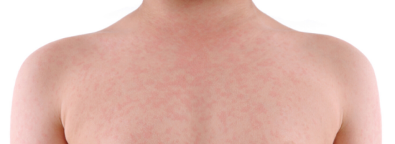 Rode vlekken na douchen | Tips | Sproet