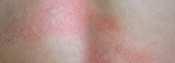 Rode vlekken na douchen | Tips | Sproet