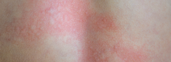 Rode vlekken na douchen | Tips | Sproet