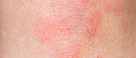 Rode Vlekken Op Huid Na Douchen