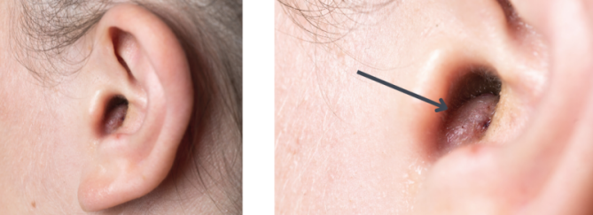 Steenpuist | Oorzaak en behandeling | Sproet