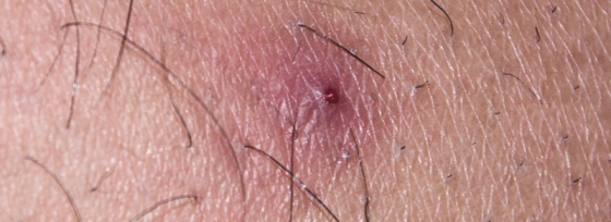 Steenpuist | Oorzaak en behandeling | Sproet