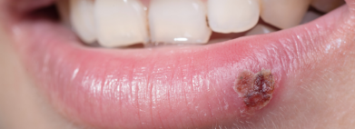 herpes-labialis-koortslip-mijn-tips-als-huidtherapeut