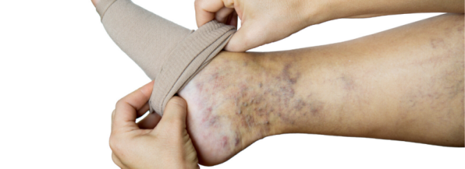 Rode plek op onderbeen | Oorzaak en oplossing | Sproet