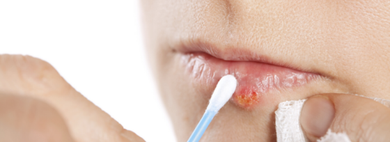 Herpes labialis: koortslip | Mijn tips als huidtherapeut