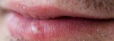 herpes-labialis-koortslip-mijn-tips-als-huidtherapeut