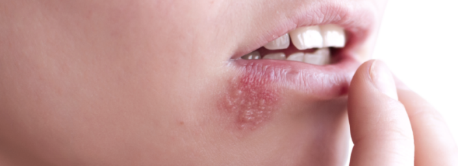 Herpes labialis: koortslip | Mijn tips als huidtherapeut
