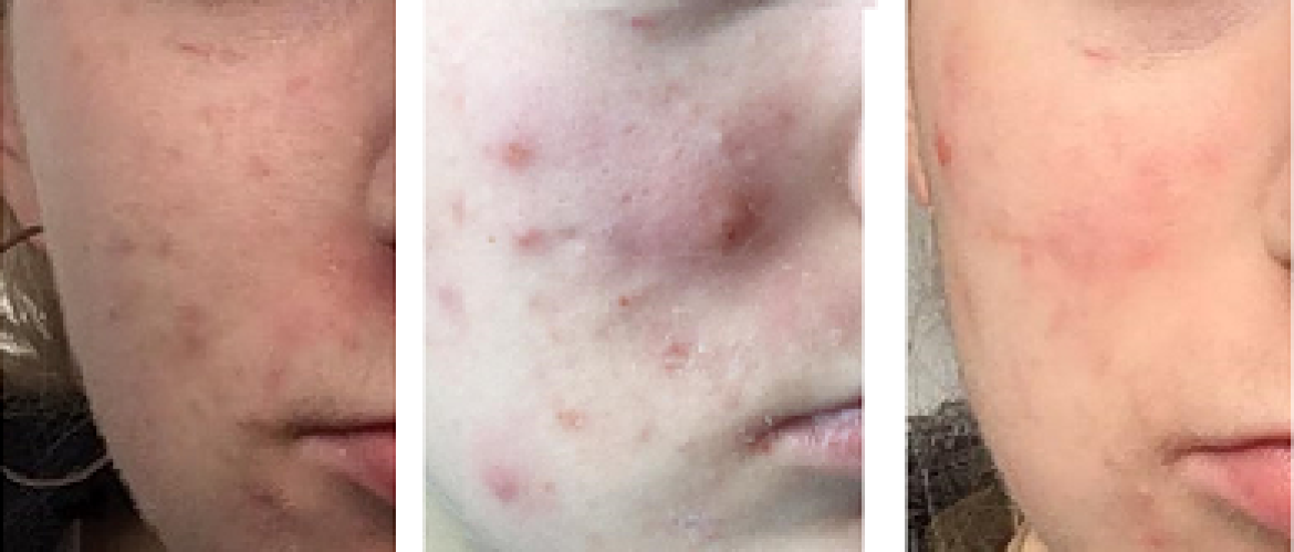 Gastblog 9. Roaccutane kuur acne