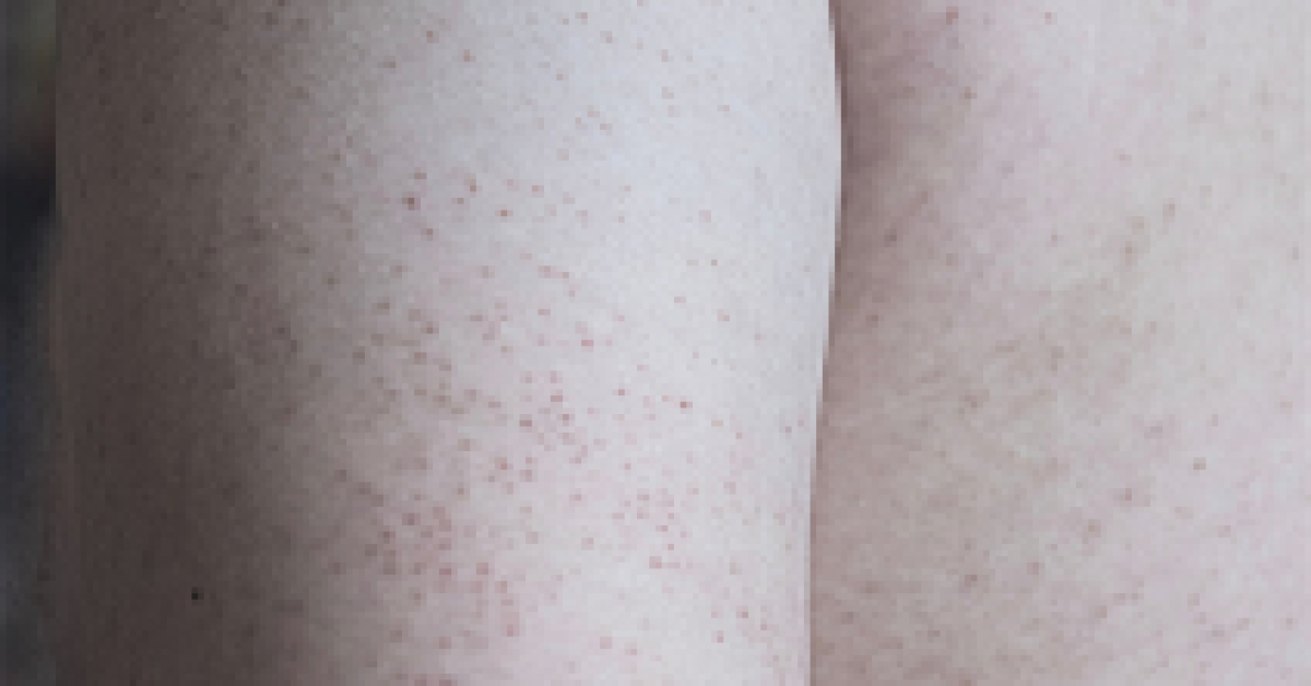 Gratis productadvies voor keratosis pilaris
