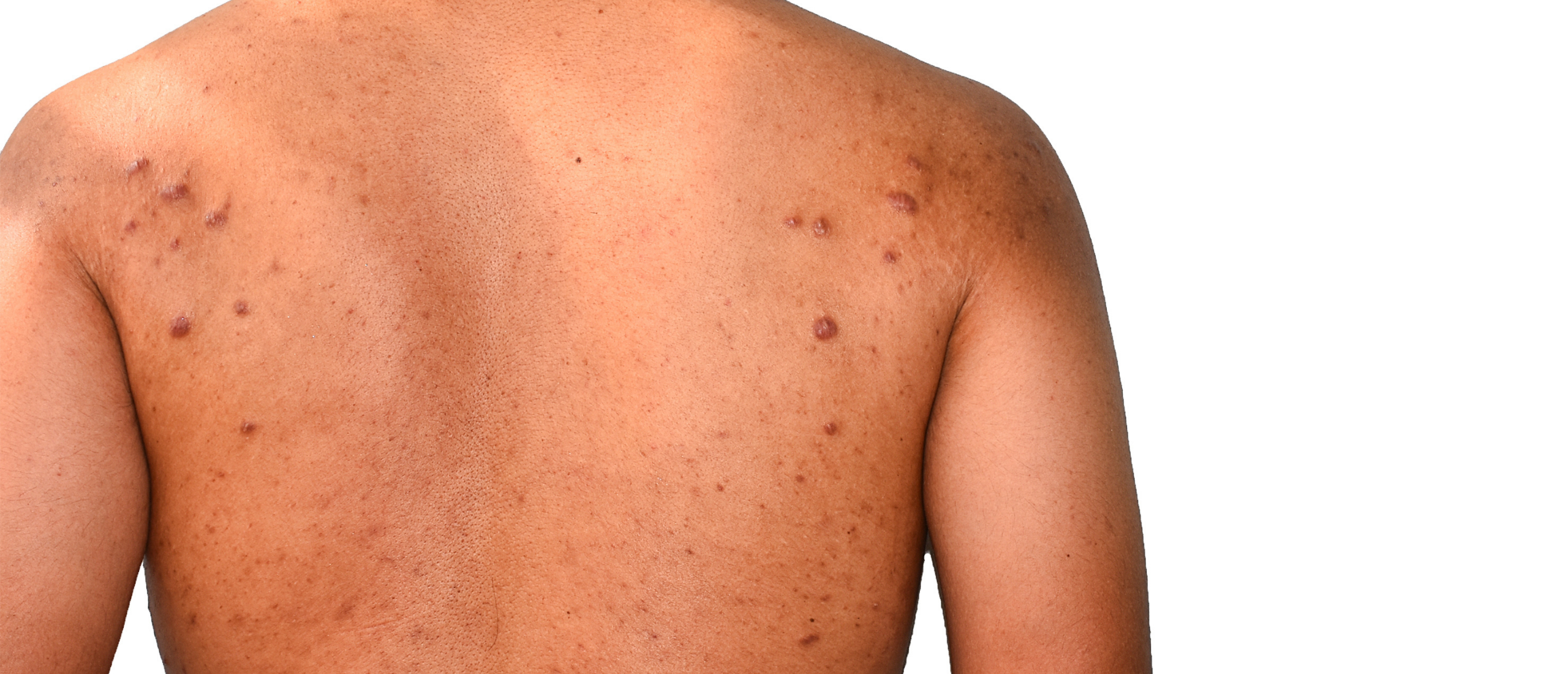 Acne keloidalis: acne littekens