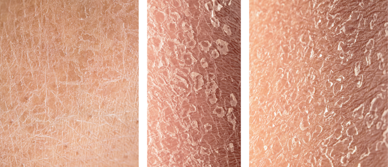 Vissenhuid Ichthyosis Sproet Vissenhuid Ichthyosis Sproet
