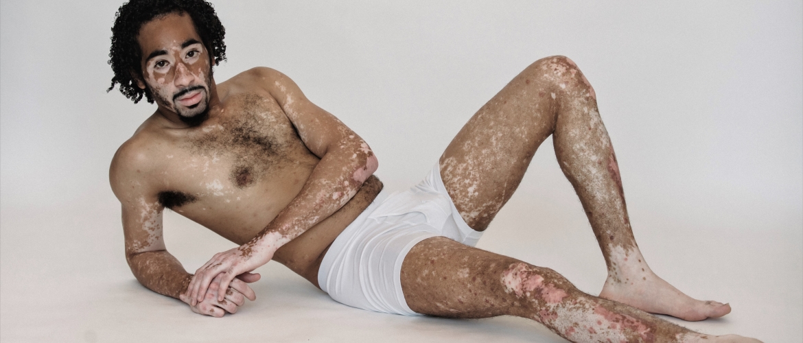 Vitiligo: witte plekken op de huid