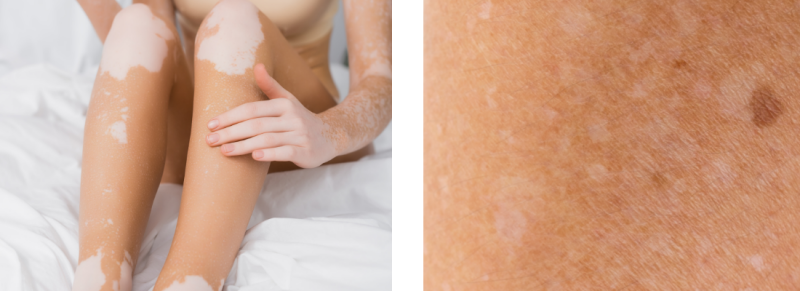 vitiligo