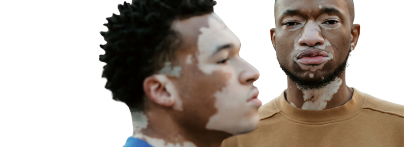 vitiligo model