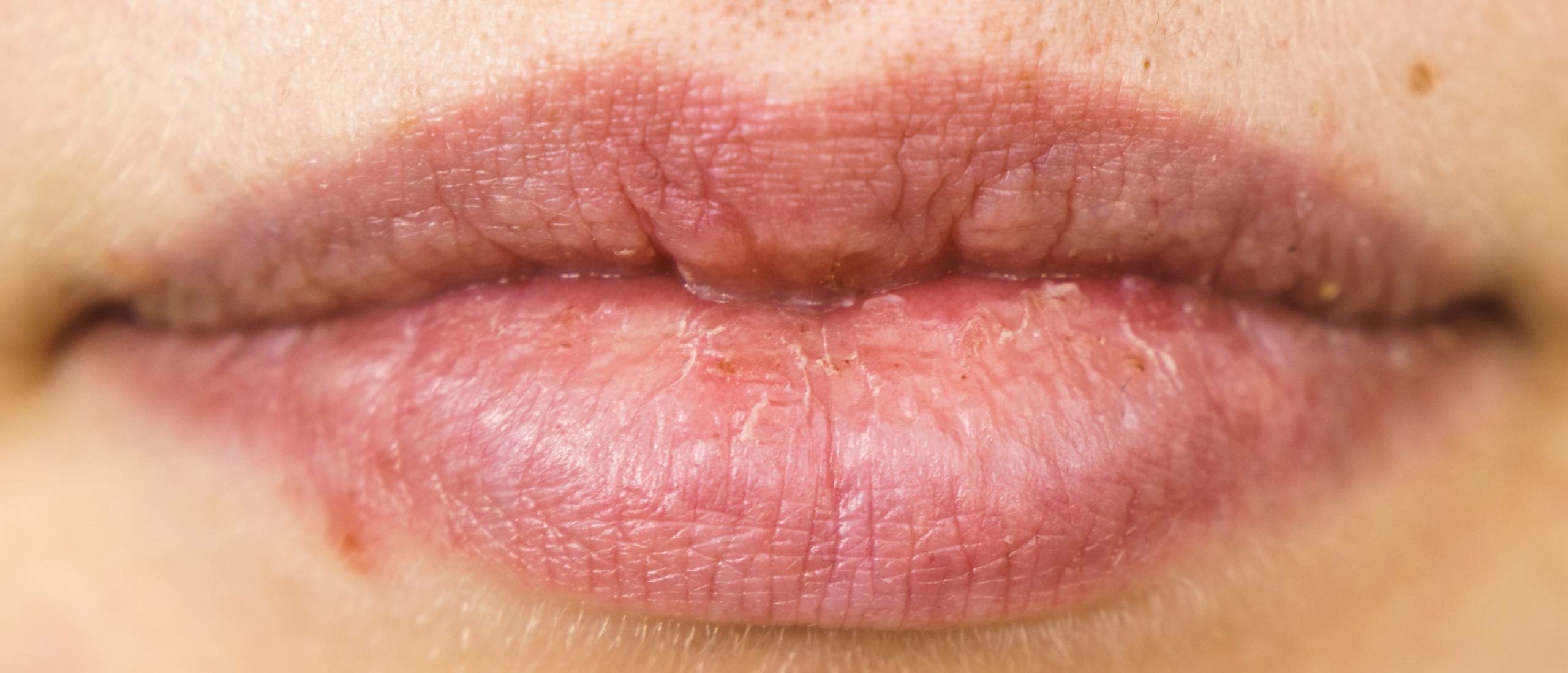 hoe lang duurt een koortslip1