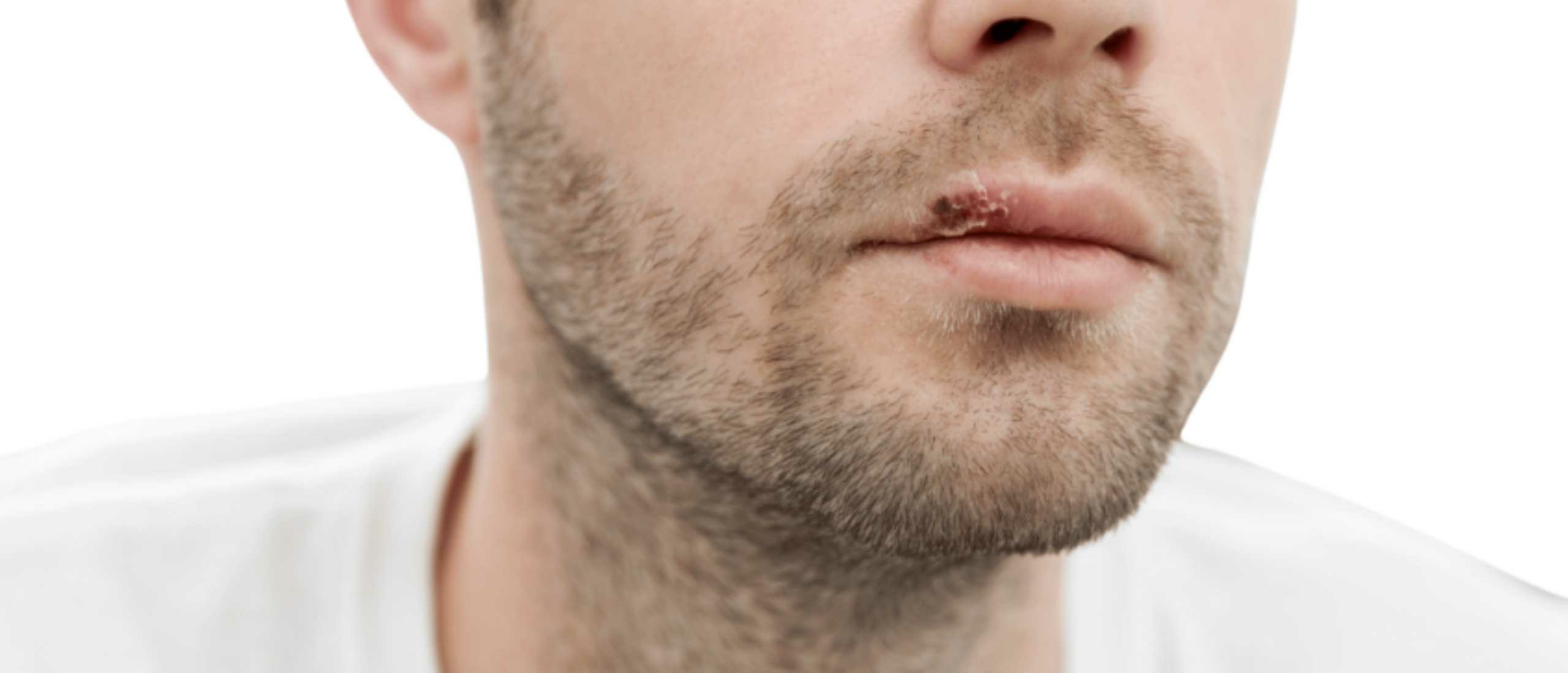 is een koortslip een soa