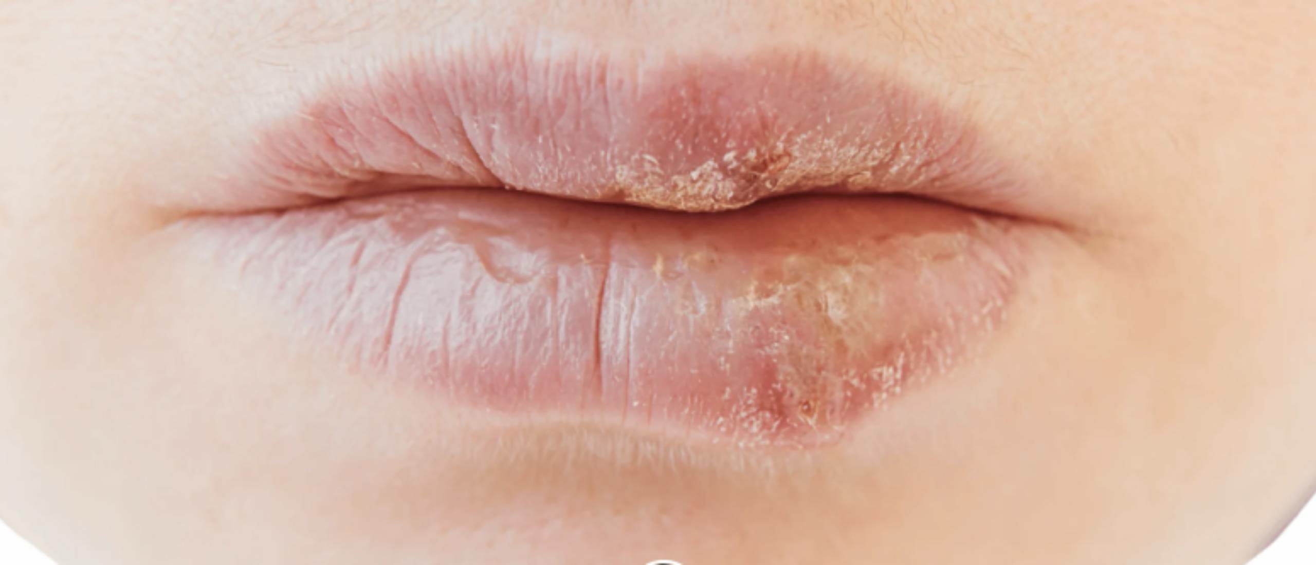 wanneer is een koortslip niet meer besmettelijk