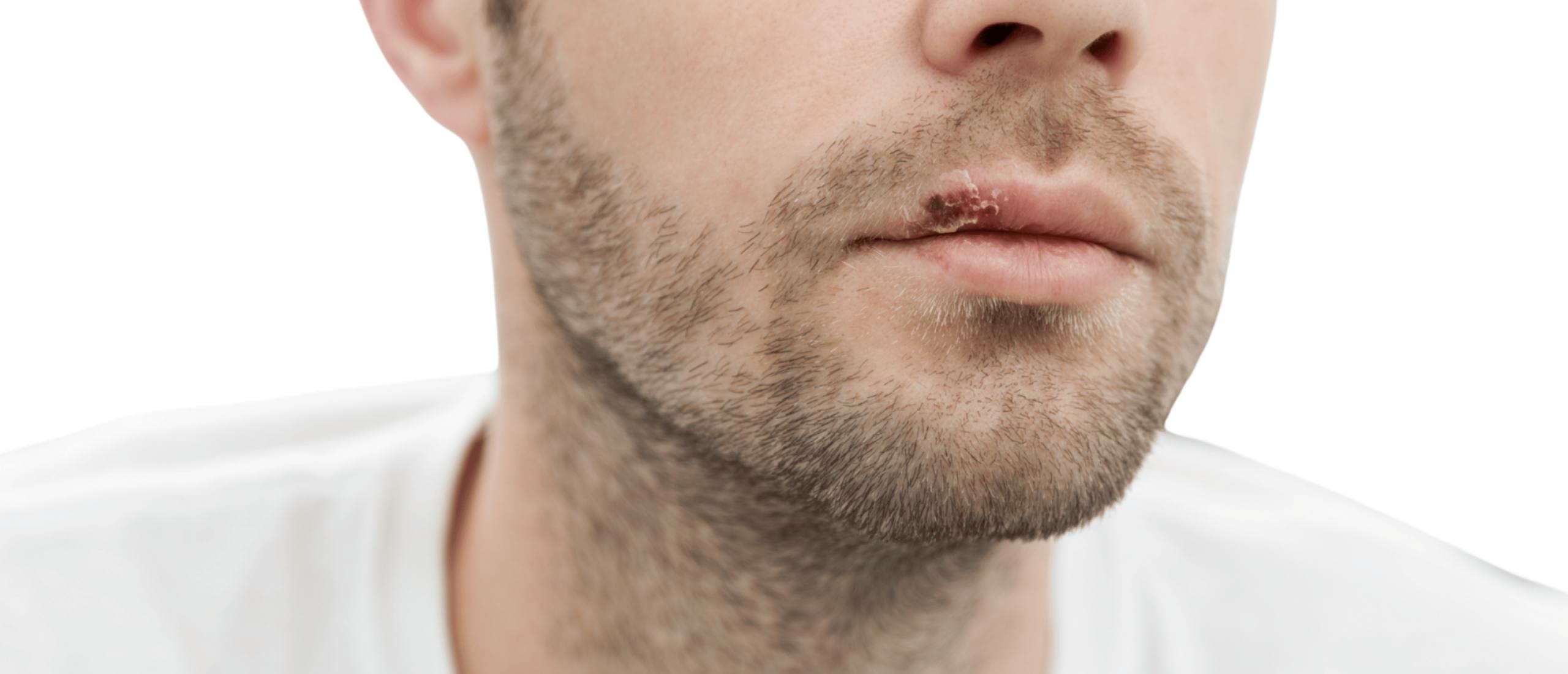 wat is een koortslip wat is een koortslip