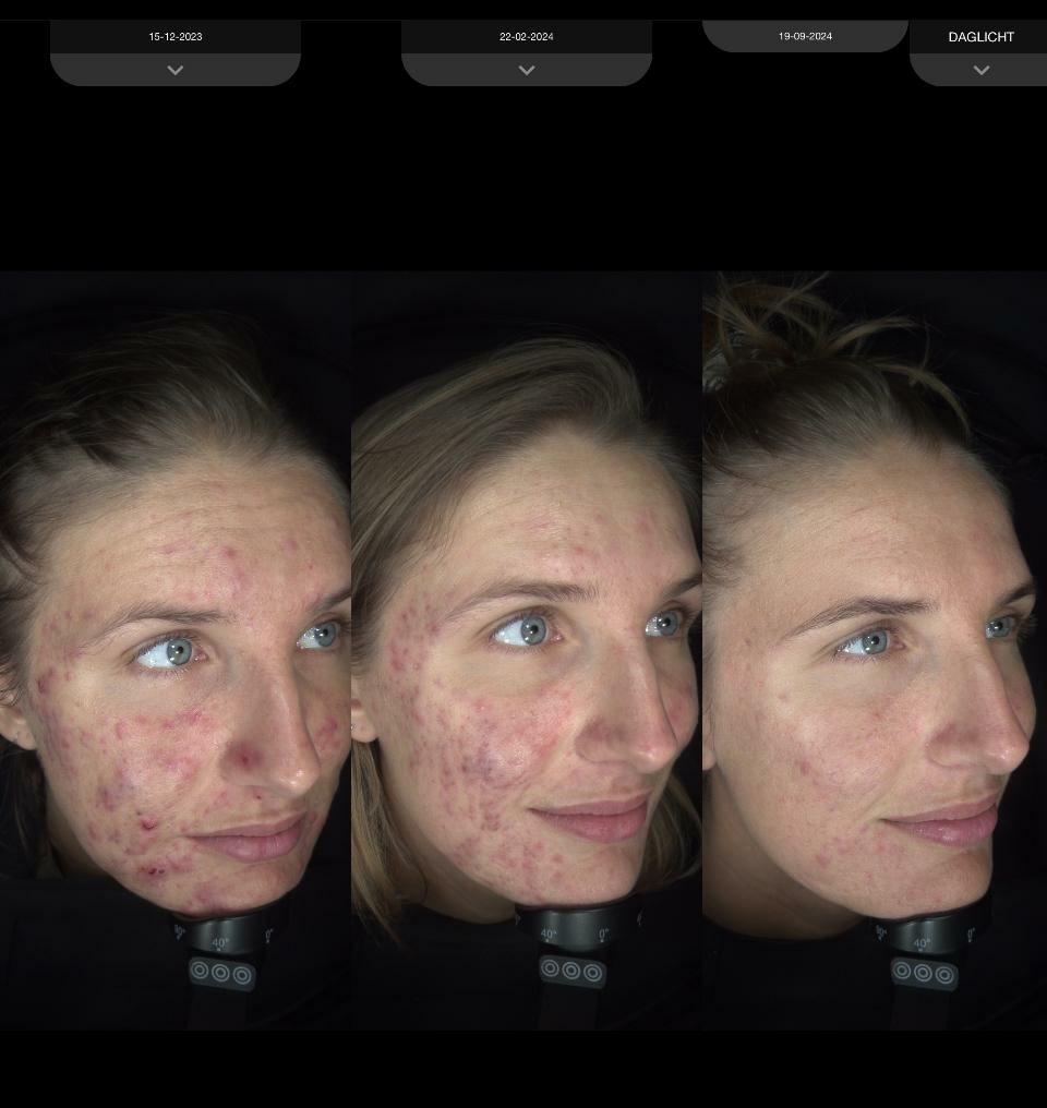 acne-traject-charlotte-steijaert-huidgezondheid-1
