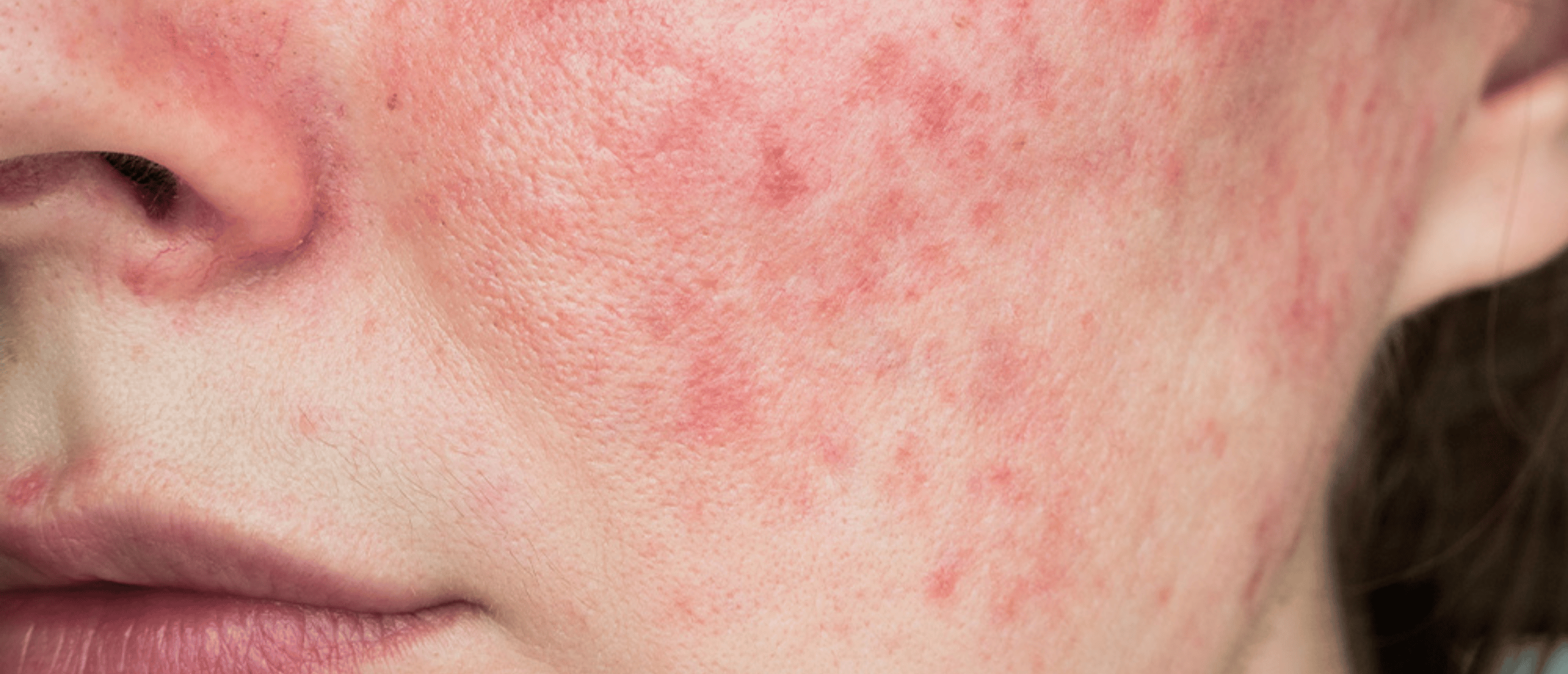 blog-voeding-en-rosacea-wat-kun-je-beter-wel-en-niet-eten-charlotte-steijaert-huidgezondheid