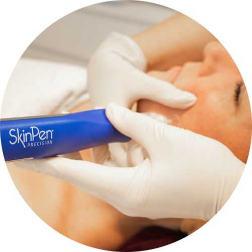 microneedling-charlotte-steijaert-huidgezondheid-1